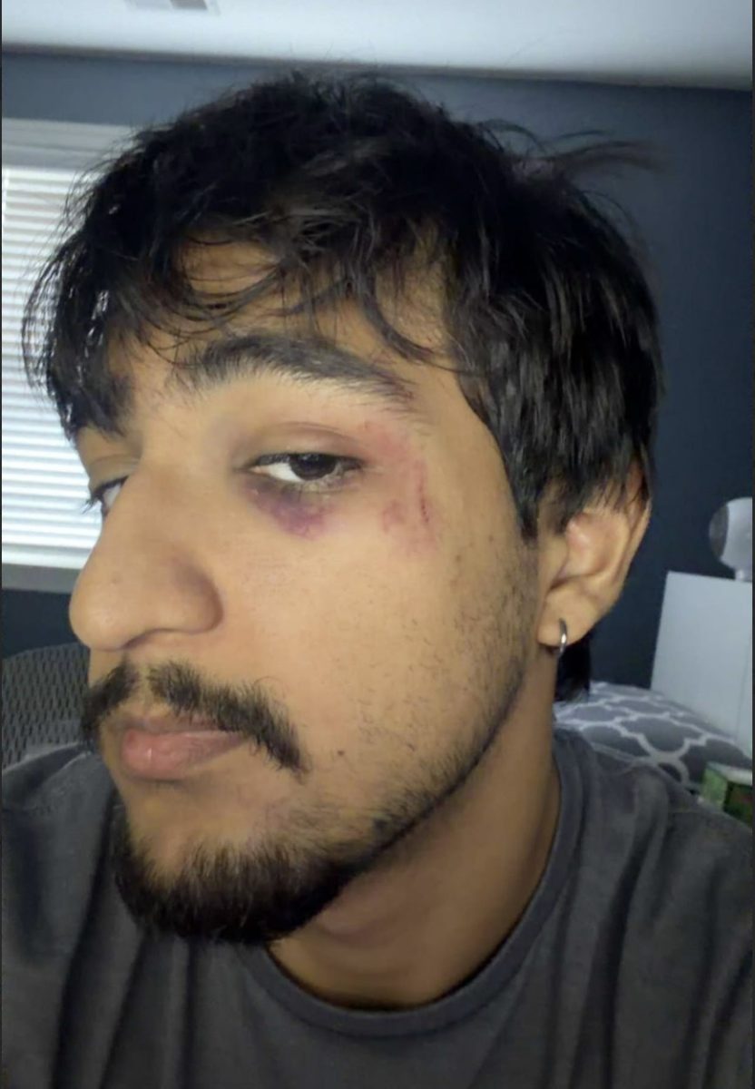 Jashan's black eye after unfortunate sledding incident. 